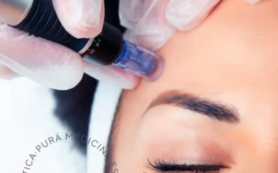 Equipamiento Avanzado en Estética: Potencia tu belleza natural con Indiba y Dermaroller